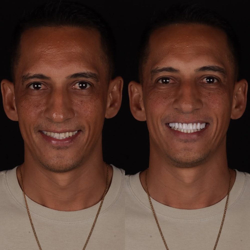 Antes e depois de paciente da Royale
