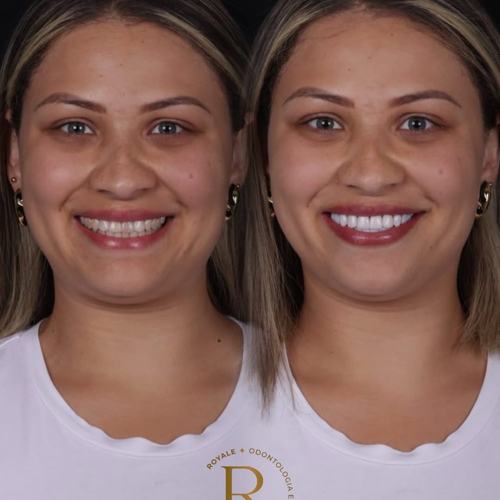 Antes e depois de paciente da Royale