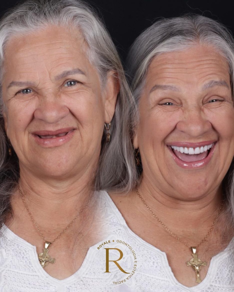 Implantes dentários